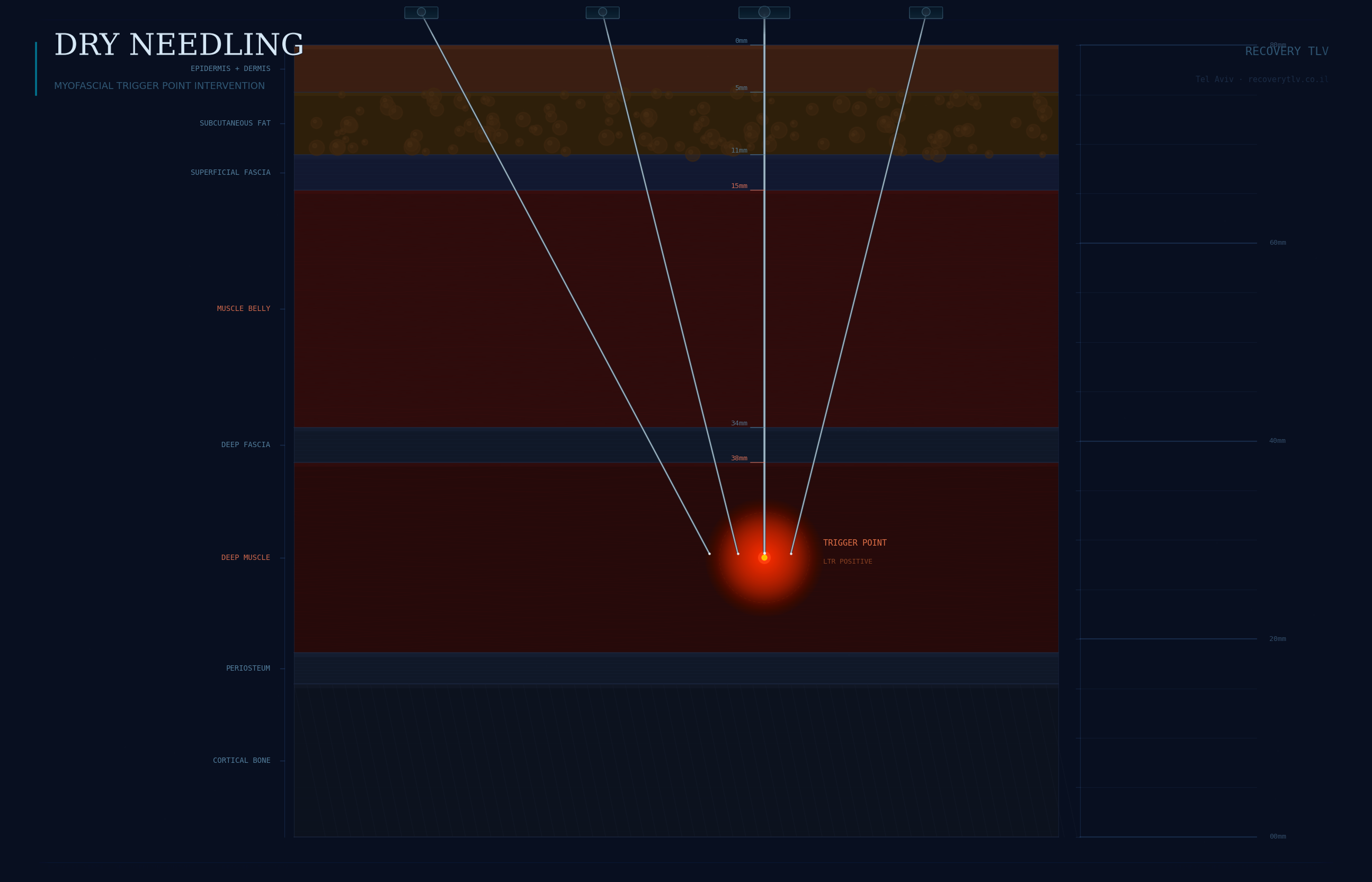 דיקור יבש — נקודות טריגר מיופאסציאליות, Recovery TLV תל אביב